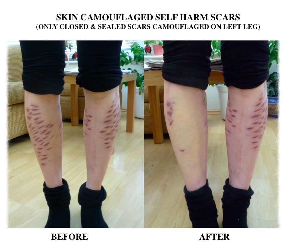 Self Harm Scars On Legs