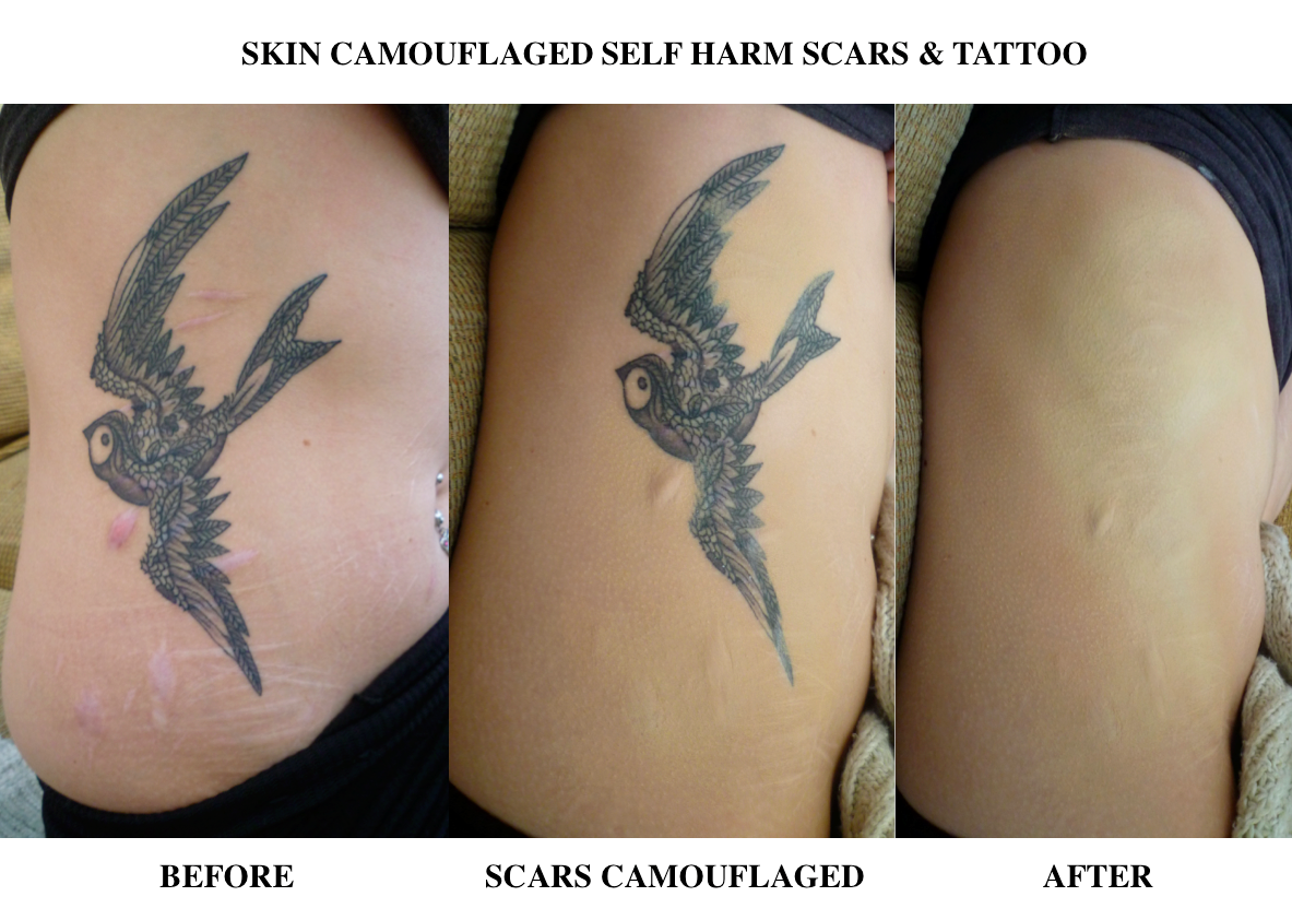 Skin Camouflage Aids Self Harm — Charlotte Trendell