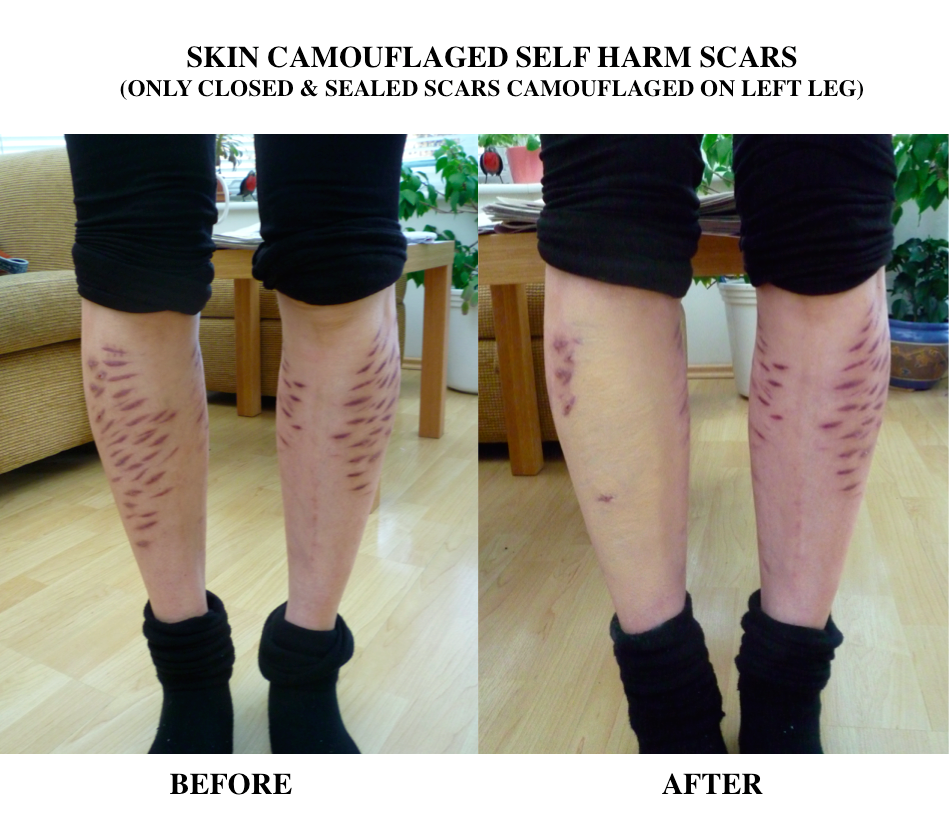 How To Cover Up Self Harm Scars On Legs With Makeup Makeup Vidalondon ...