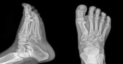 fracture.jpg
