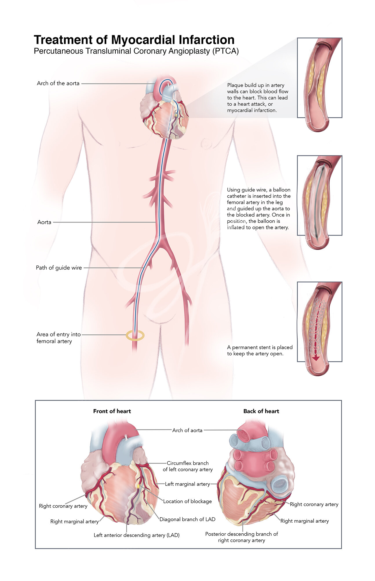   Medium:  Graphite, Photoshop, Illustrator   Objective:  To illustrate the most common configuration of the coronary arteries in the human heart. To explain myocardial infarction and percutaneous transluminal coronary angioplasty (PTCA) to patients 