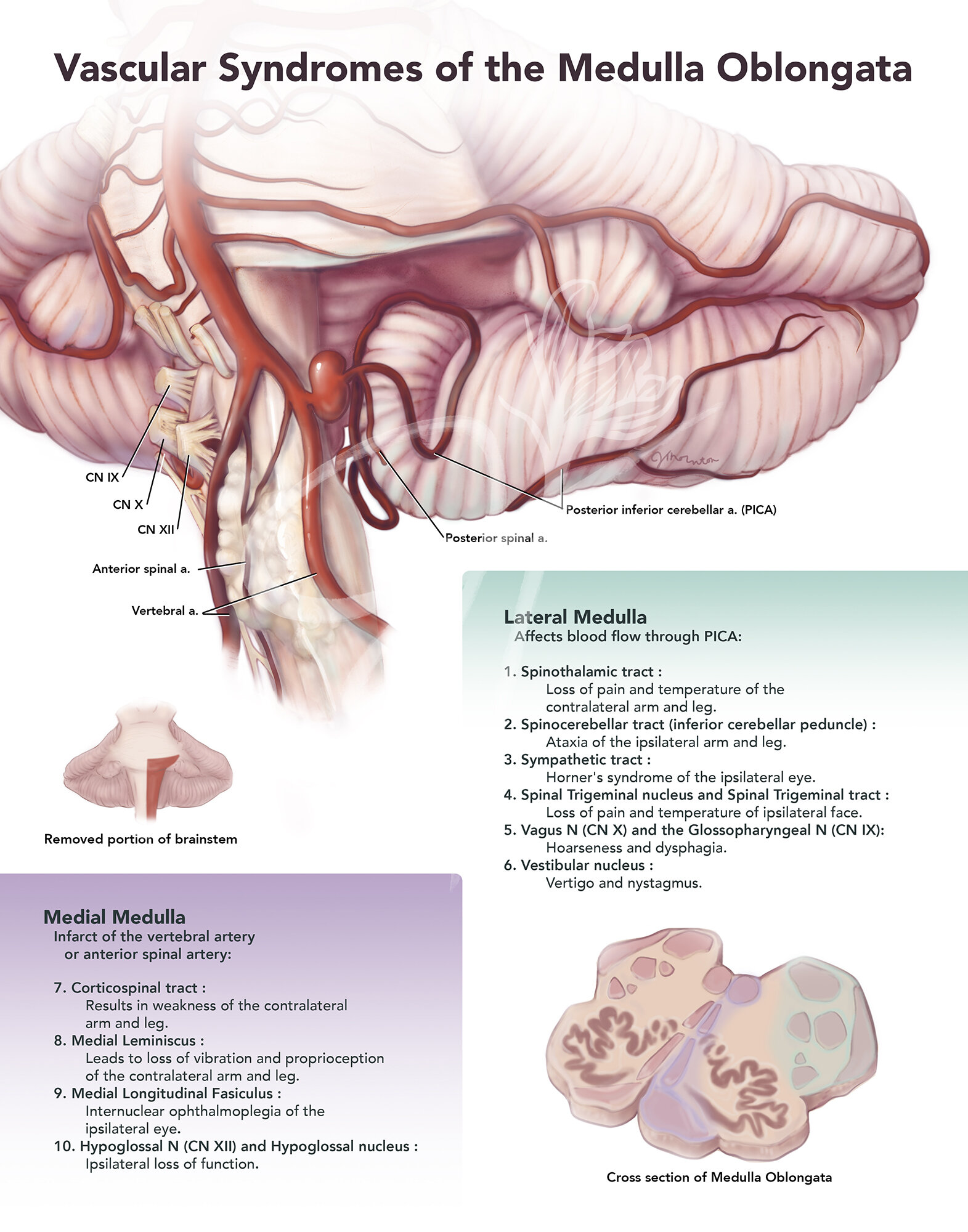   Medium:  Photoshop   Objective:  To explain to a group of medical students vascular anomalies of the medulla oblongata and their clinical presentation. 