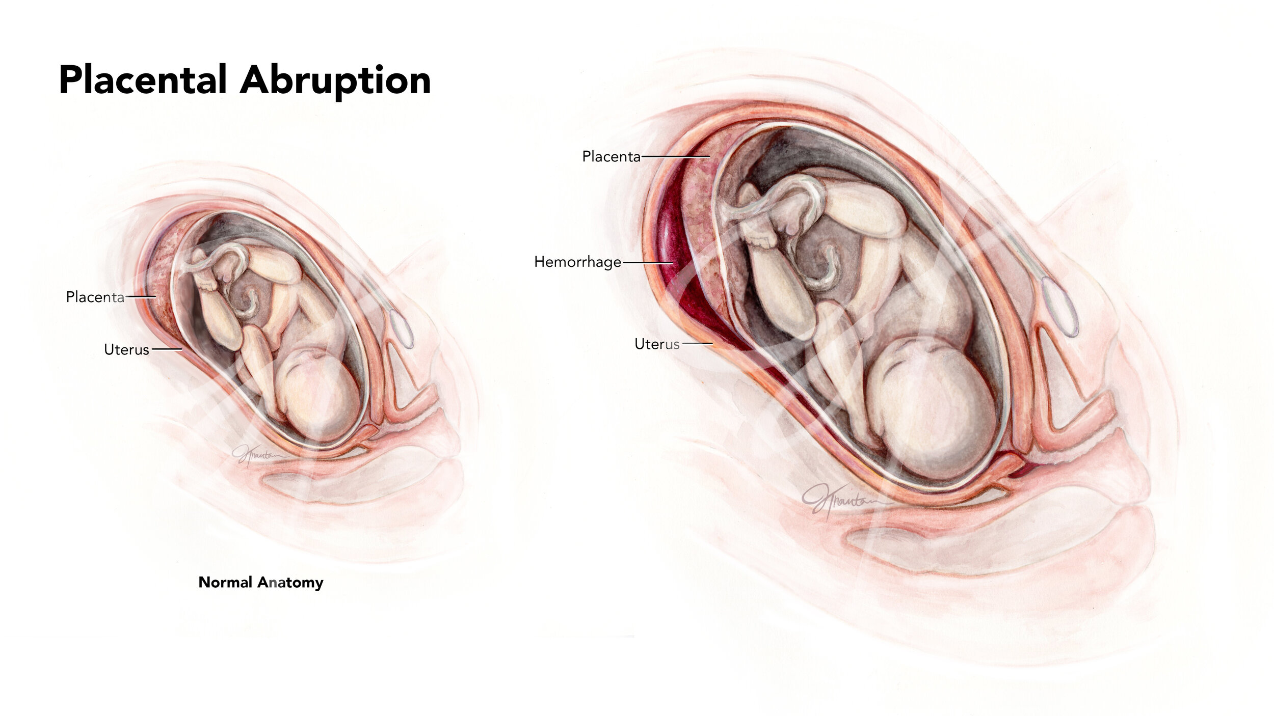   Medium:  Watercolor, Photoshop   Objective:  To illustrate to an audience of medical students the pathology of placental abruption. 