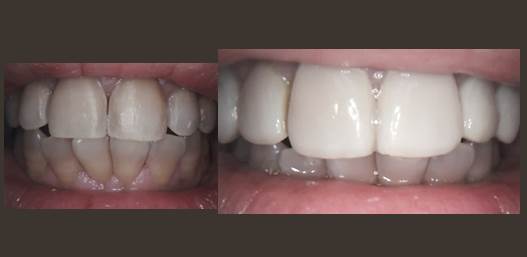 Composite veneers #6 - #11 to cover tetracyline staining