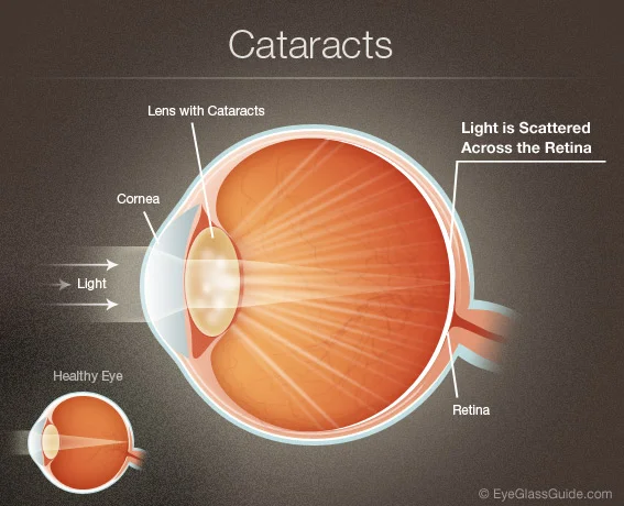 cataracts 2.jpg