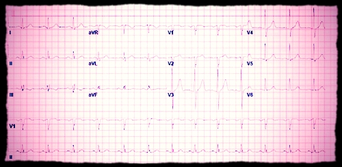 ekg.jpg