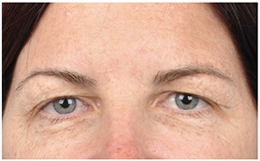 Actual "hooded" eyes