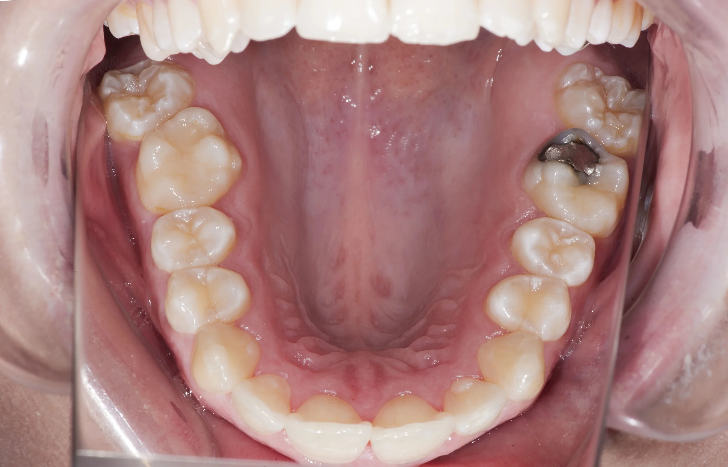 teeth bottom reflect 1.jpg