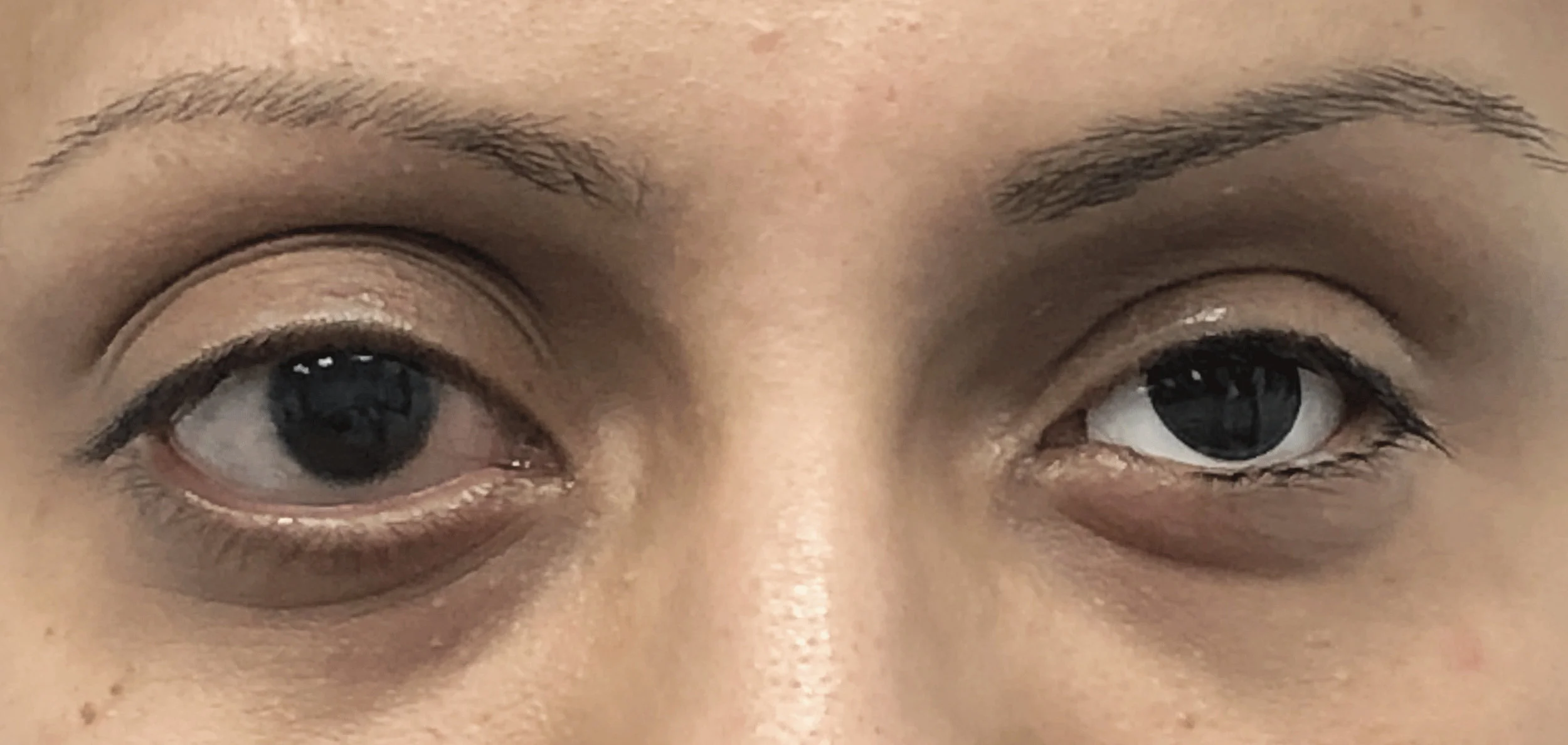 The patient is shown here wearing a stock eye.