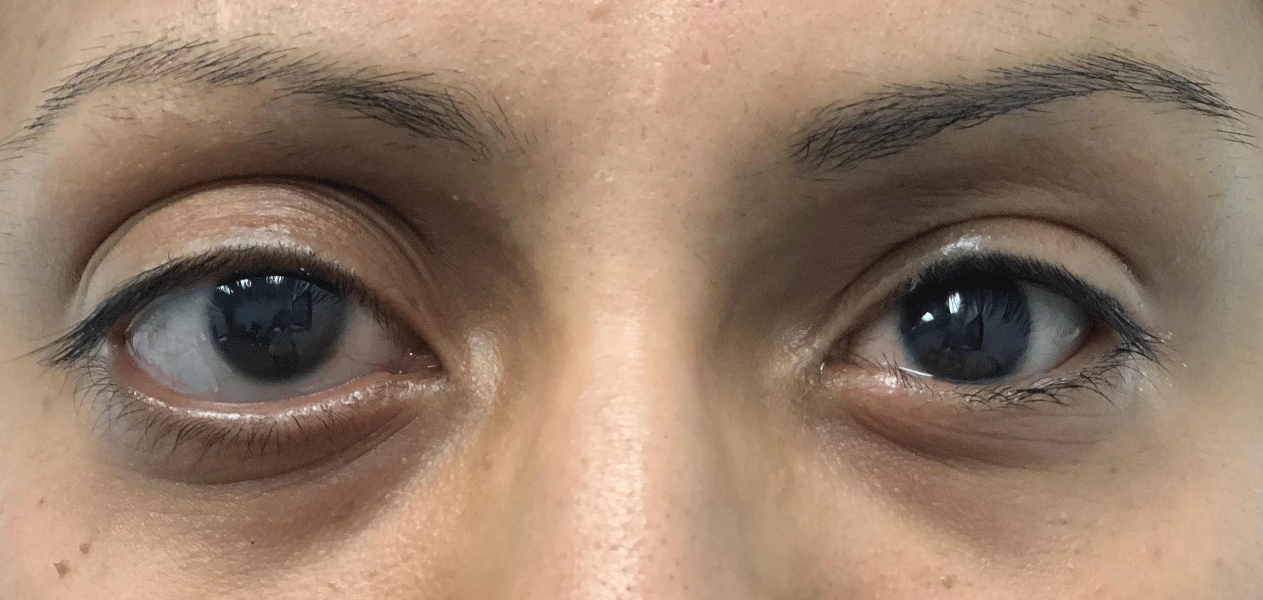 Ocular Prosthetic