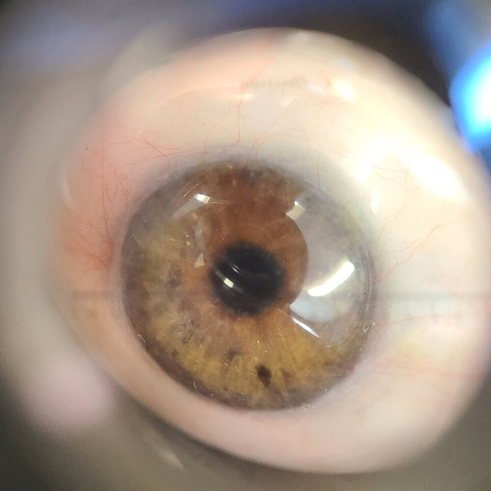 Drew Robinson prosthetic eye