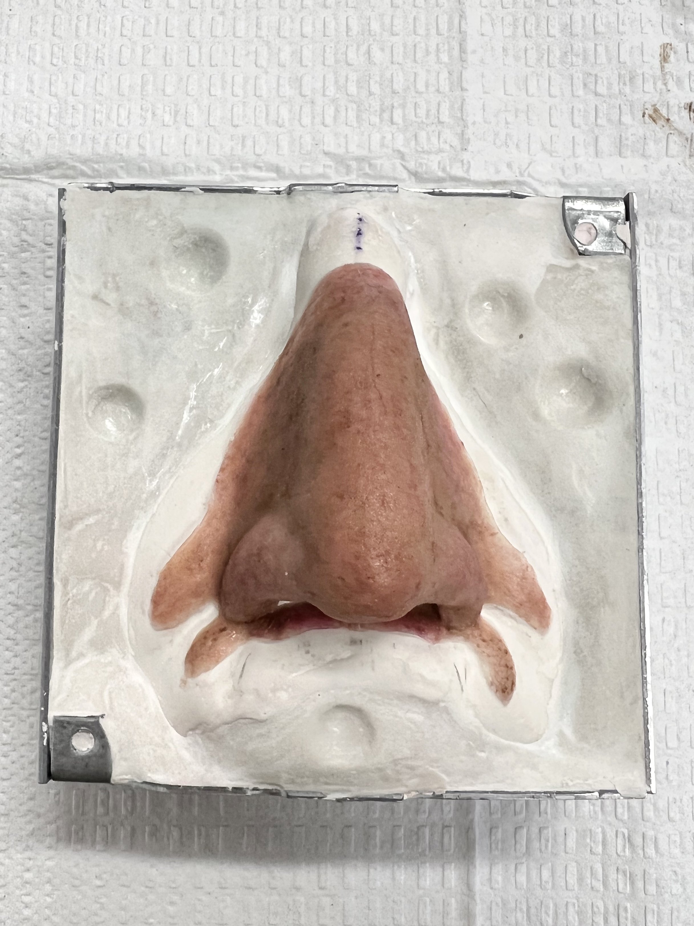 Nasal Prosthesis