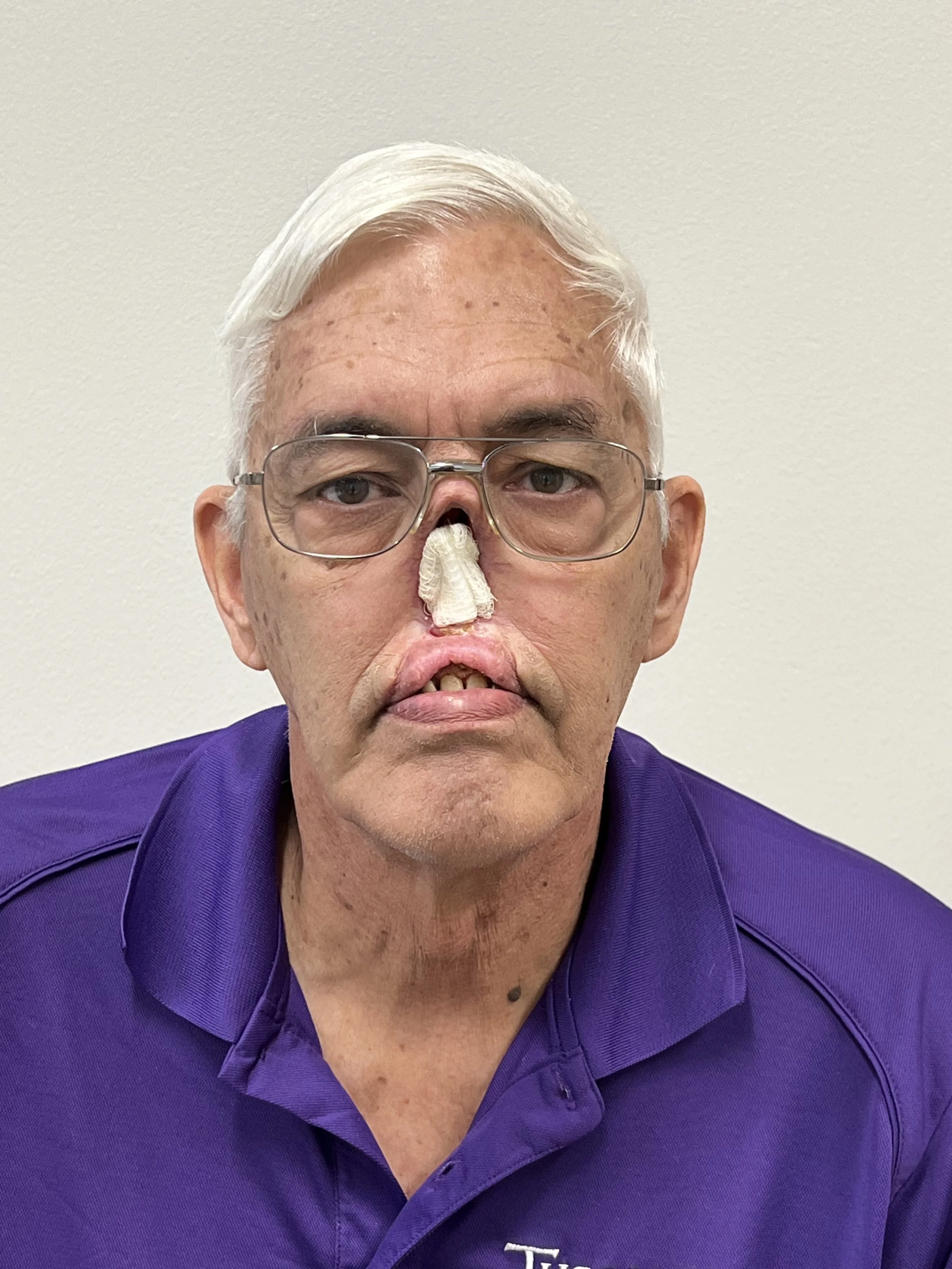 Nasal Prosthesis