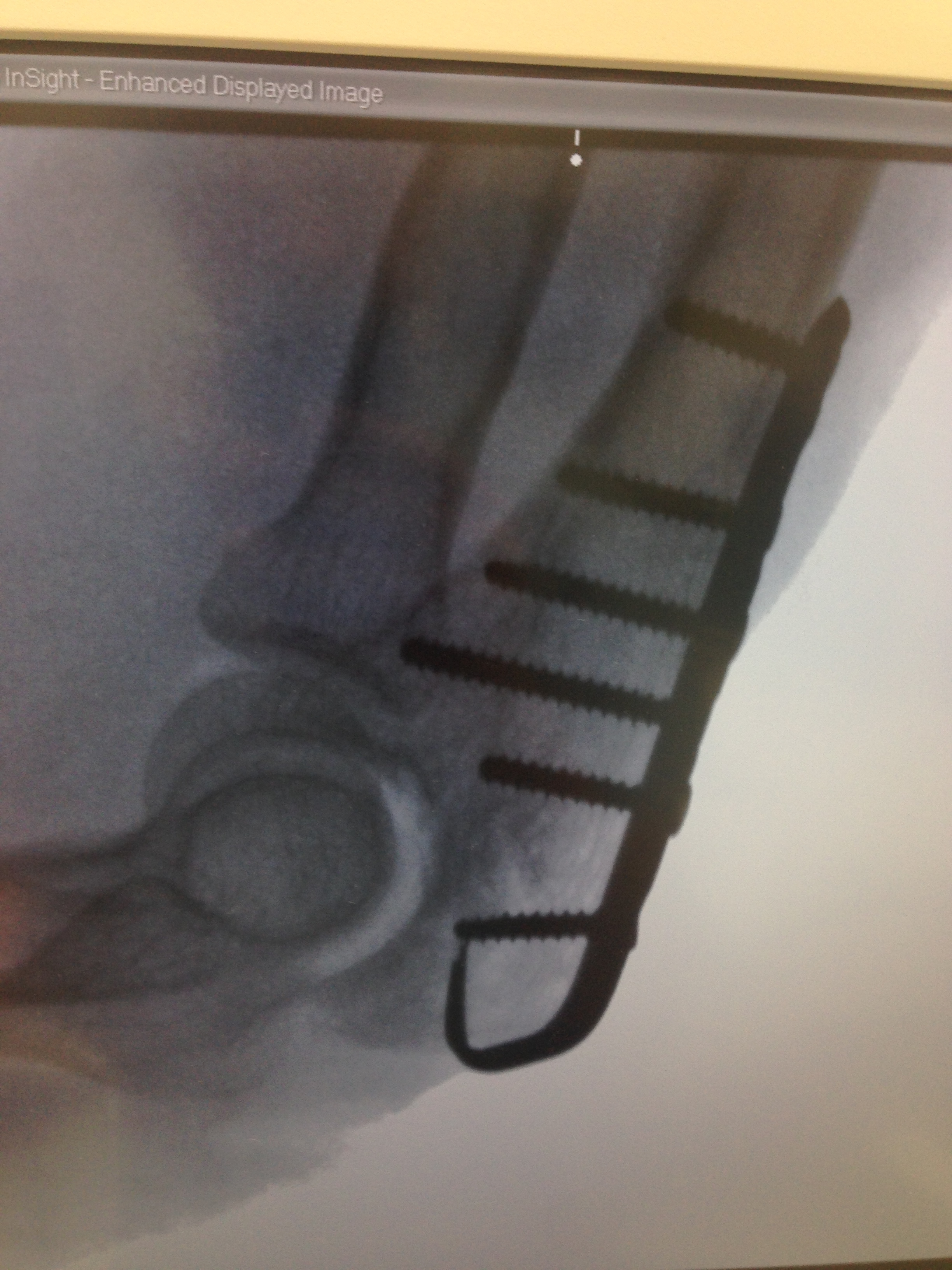 Olecranon Fractures