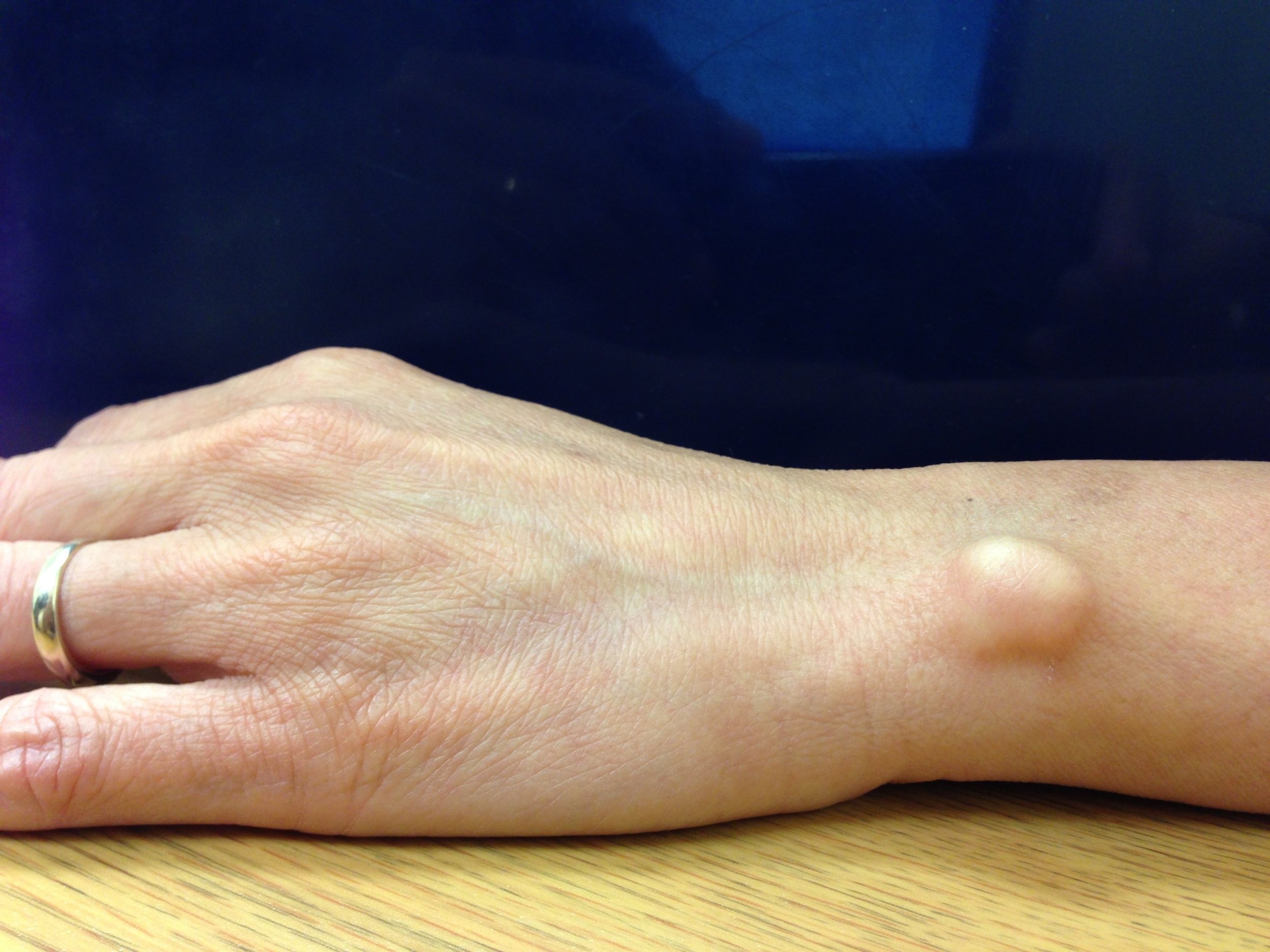 Ganglion Cysts