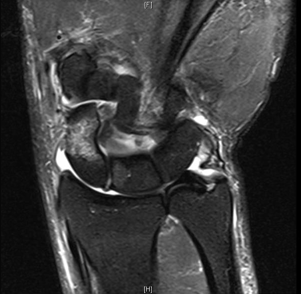 Scaphoid Fractures