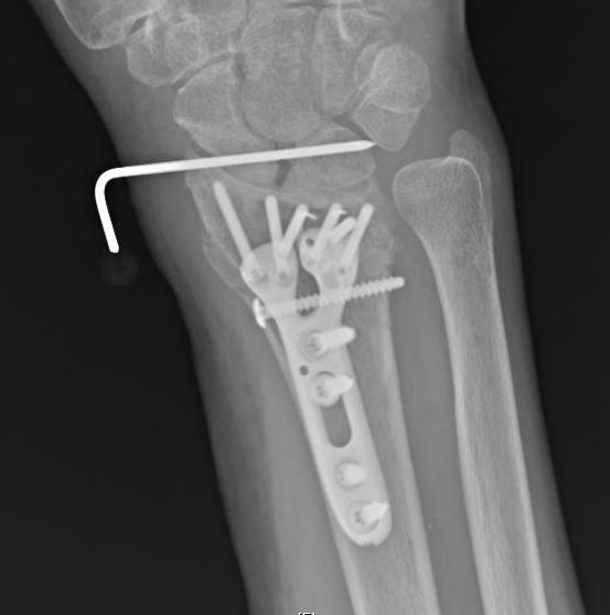 Wrist Fractures