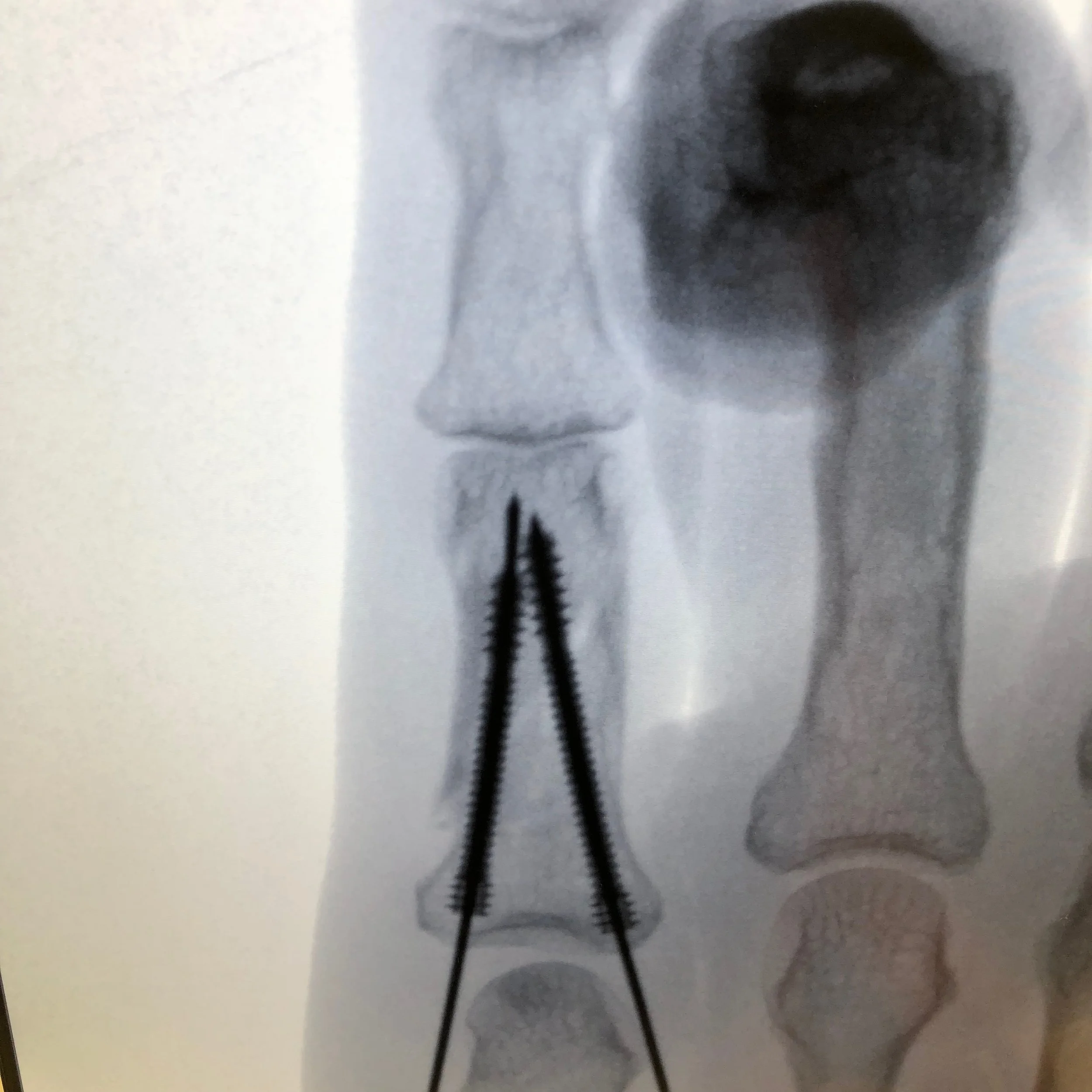 3 week Follow-up for Limited incision Finger fracture Fixation