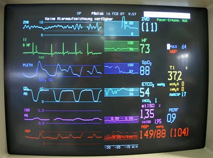 ANÄSTHESIEMONITOR ZUR KONTROLLE DER VITALFUNKTIONEN DES PATIENTEN IN NARKOSE