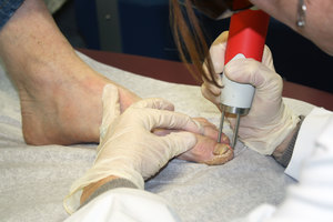Laser Light Therapy-Delivered through a Q- Switched 1064nm Nd:YAG - a Safe, Painless and Highly effective solution for the treatment of onychomycosis is available right here in South Burlington, VT. One treatment with a subsequent follow up treatment three months after if necessary is all most Patients ever require
