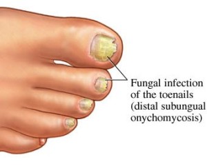 Onychomycosis (also known as "dermatophytic onychomycosis," or "tinea unguium") is a fungal infection of the nail. It is the most common disease of the nails and constitutes about half of all nail abnormalities. Instantly effective, laser treatment is the best solution for toenail fungus. Laser treatment of Onychmycosis is a safe and painless procedure with excellent long-term results.