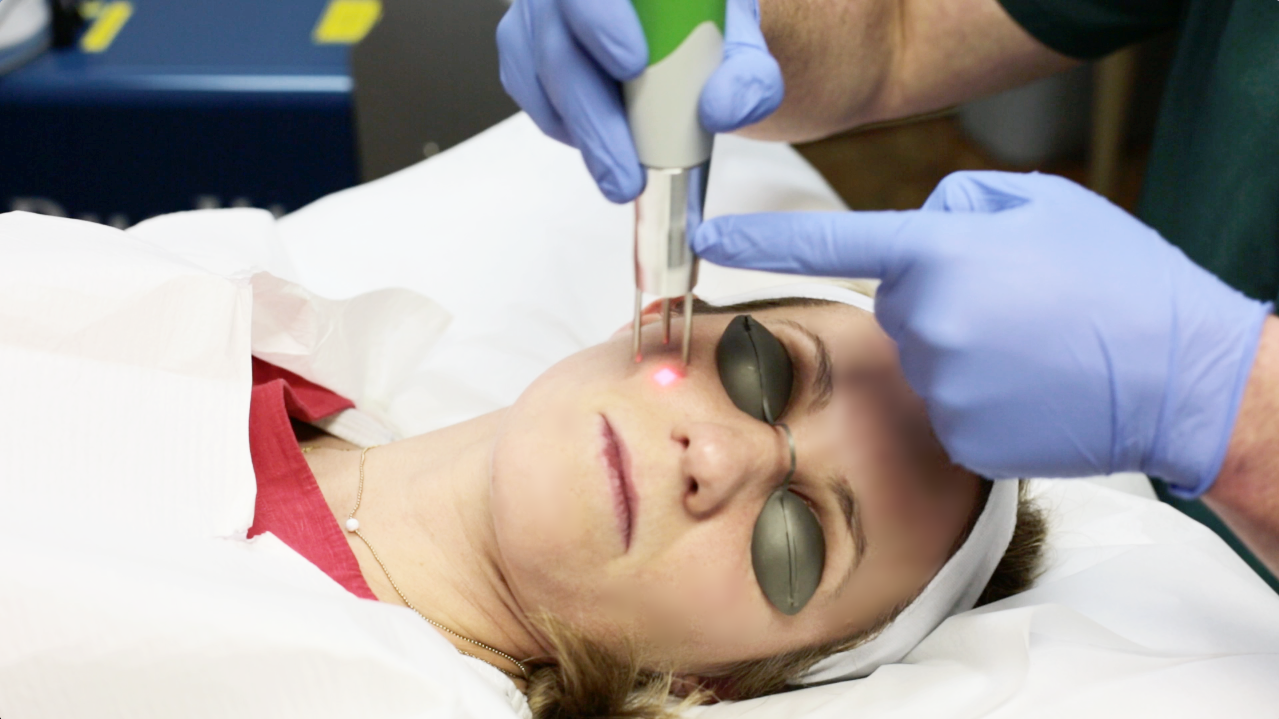 Laser Facial Peel