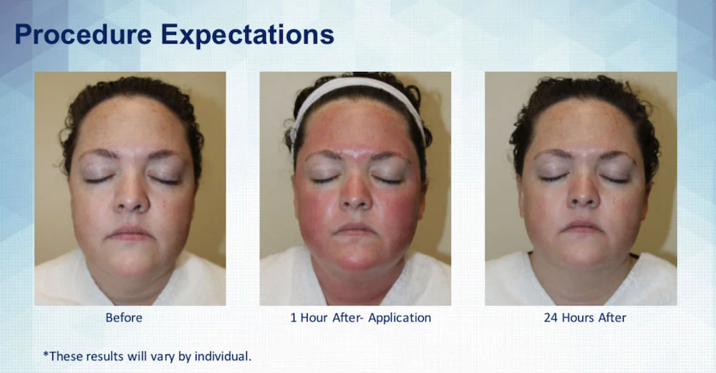 skinpen-procedure-expecations.jpg