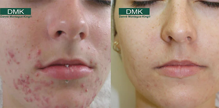 right_acne3.jpg