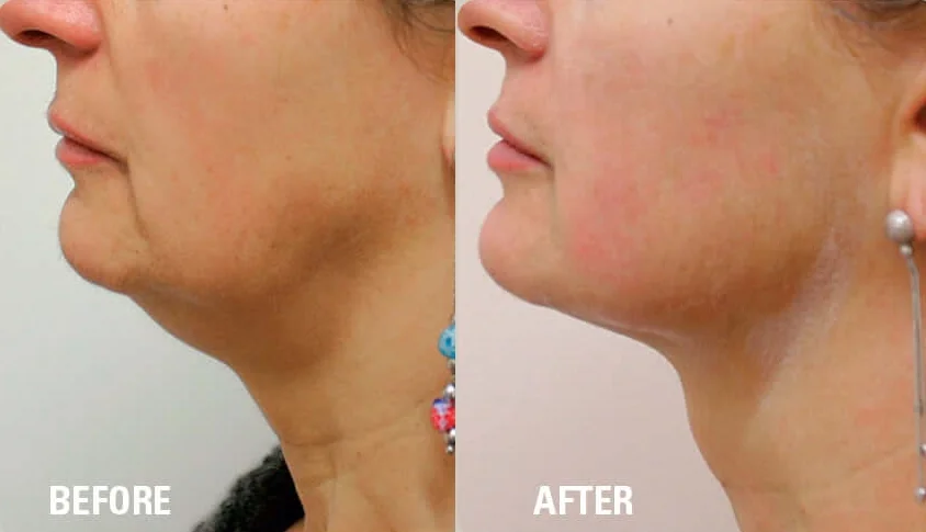 Ultraformer HIFU Before & After.jpg