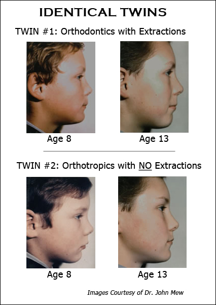 Orthodontics Vs Orthotropics Aligne Orthodontics And Orthotropics