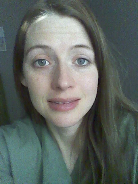 This was on day 3. I cant get the guts to post day 6 picture of my face. My camera phone doesn't help either