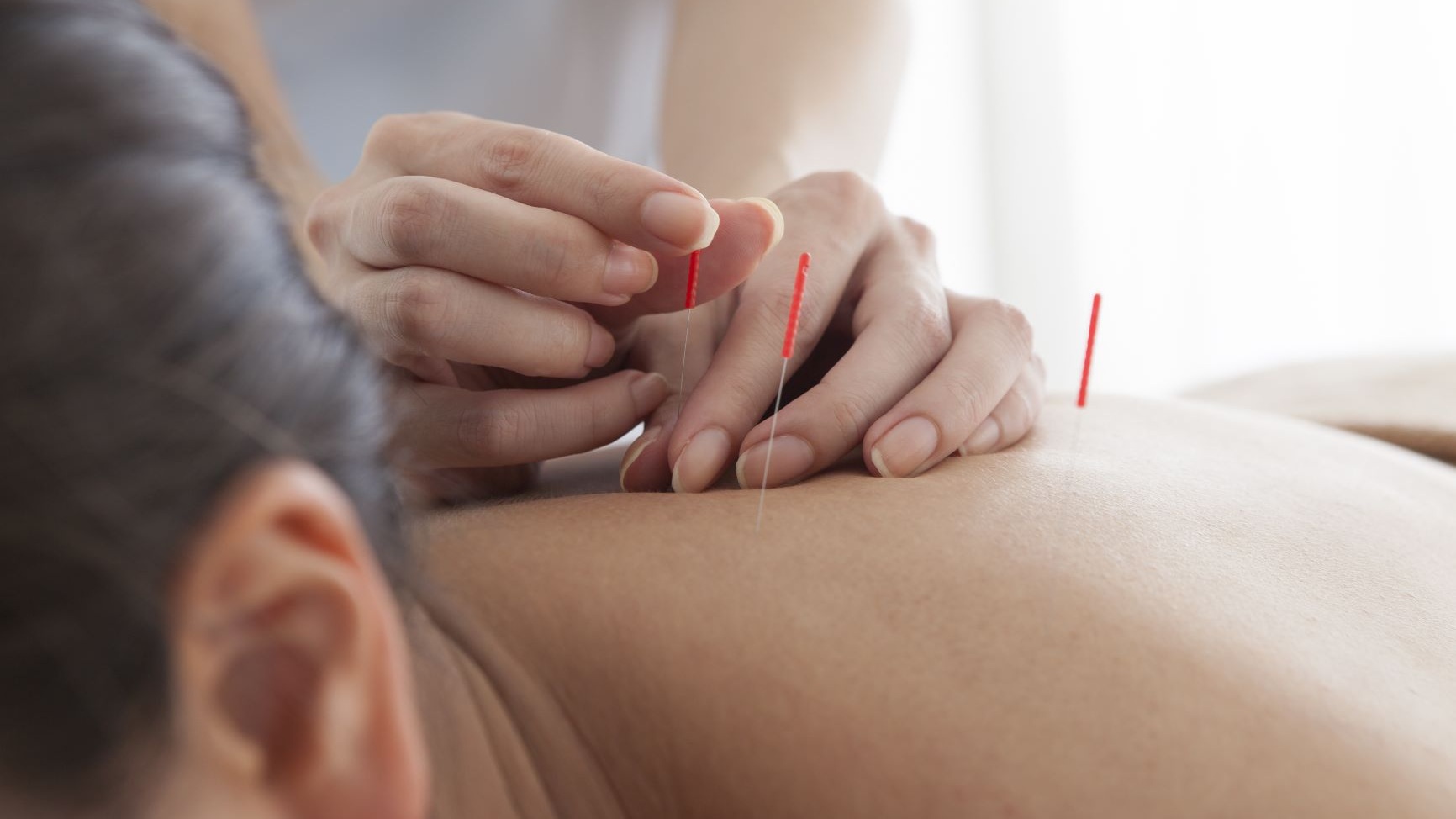 dry+needling+smaller+image+size.jpg