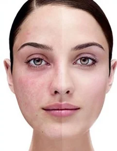 What is Microneedling?