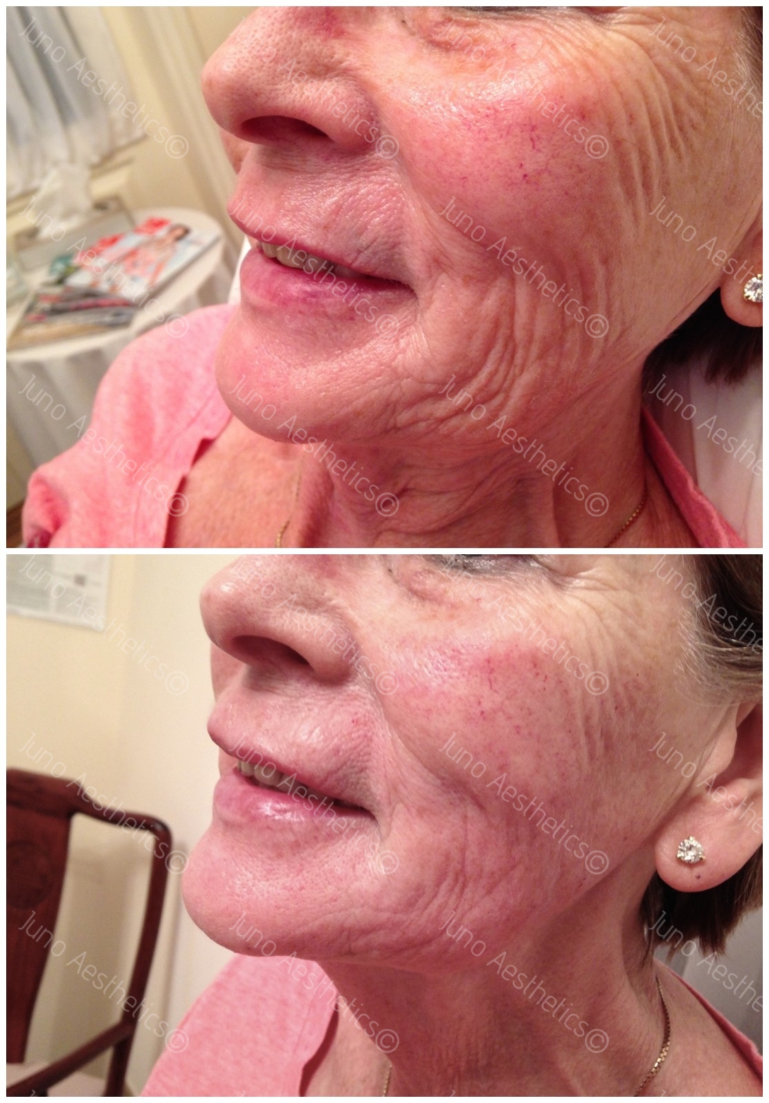 Mesotherapy on Mature Skin