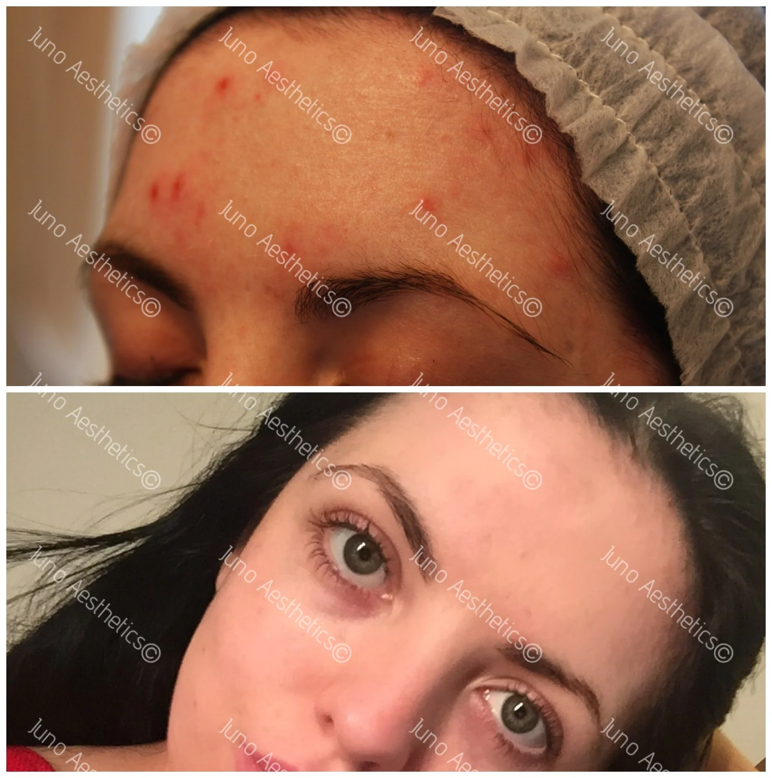 Mesotherapy & Dermarolling on Young Skin