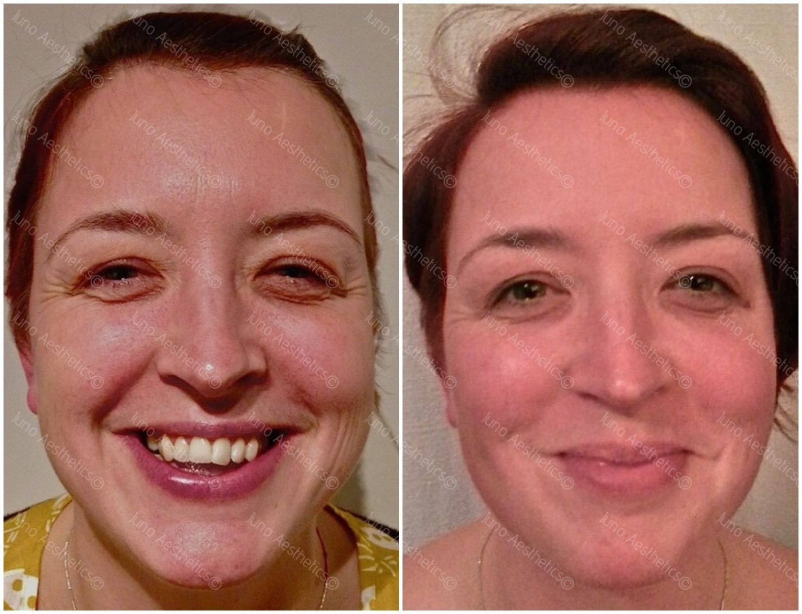 Mesotherapy - results after just one session