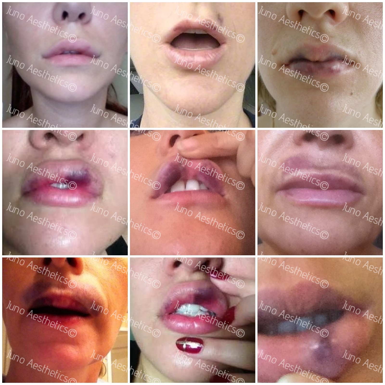 Tips To Reduce Lip Filler Swelling And Bruising | Elite Medical & Aesthetics | Lone Tree, Co 80124