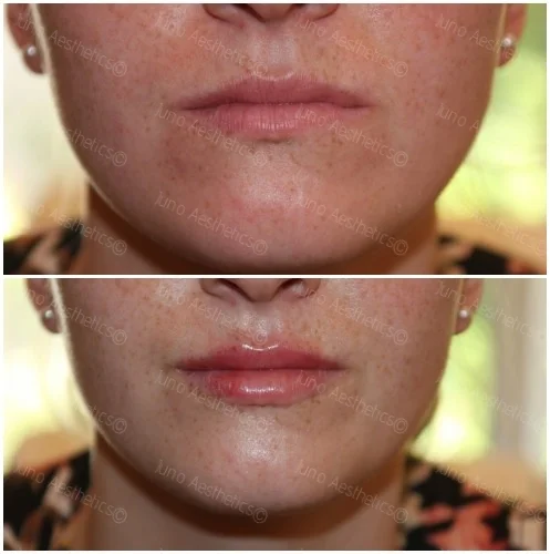 Subtle enhancement - half ml treatment