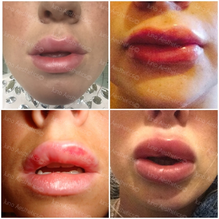 How To Reduce Swelling After Lip Fillers? 