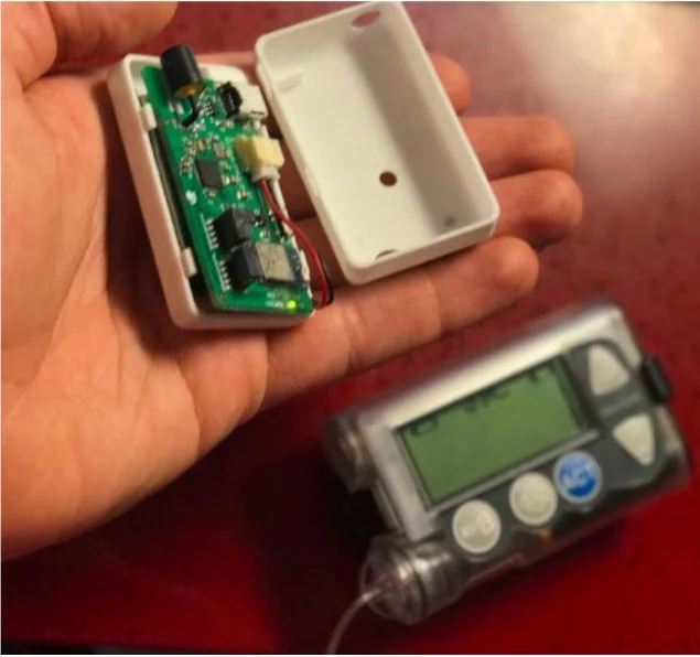 DIY Artificial Pancreas “Loop” Study