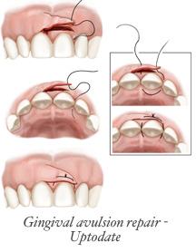 Gingiva.jpg