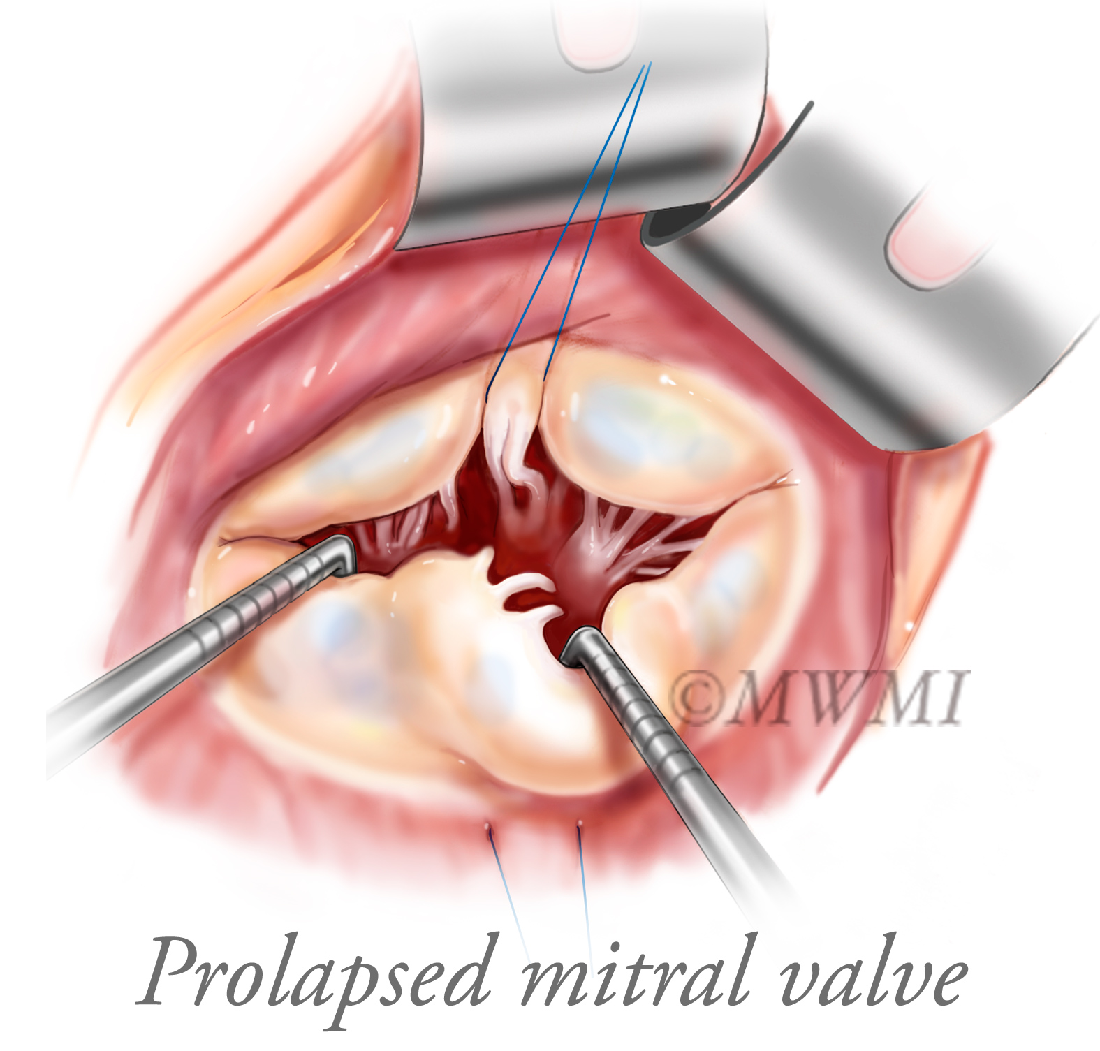 Mitral.jpg