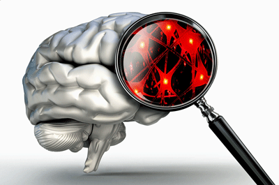 Neuroinflamação no autismo e síndrome de Down