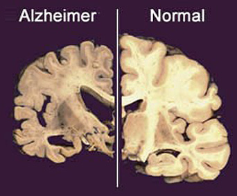 alzheimer.jpg