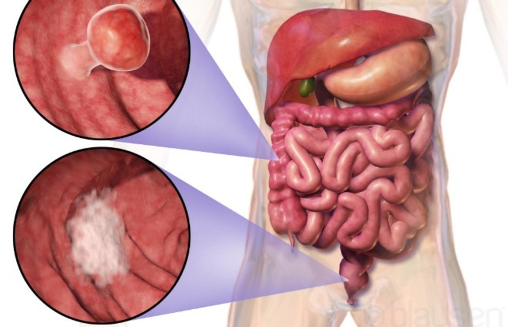 Preven&ccedil;&atilde;o e tratamento do c&acirc;ncer de intestino &mdash; ANDREIA TORRES