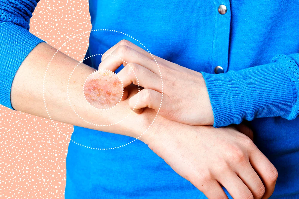 psoriase.jpg