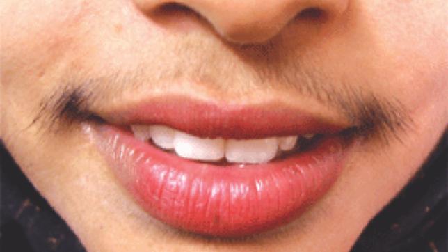 hirsutism.jpg