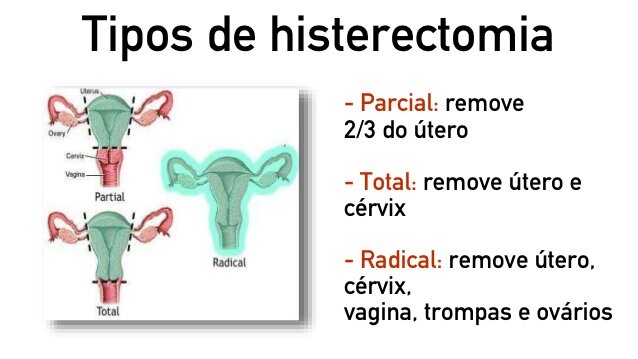 Histerectomia