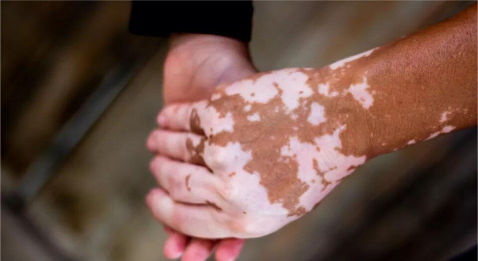 Vitiligo, estresse oxidativo e cuidado integrativo