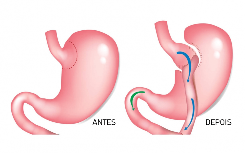 cirurgia-bariatrica-bypass.png